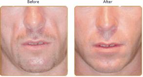 Remove Wrinkles With Dermal Fillers -: HGH Anti Aging Blog